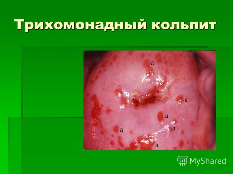 кольпит трихомонадный фото