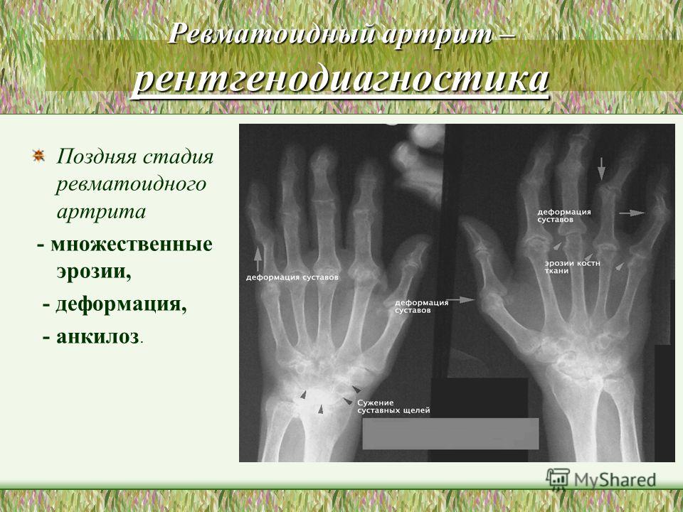Артрит раннее лечение Артрит раннее лечение