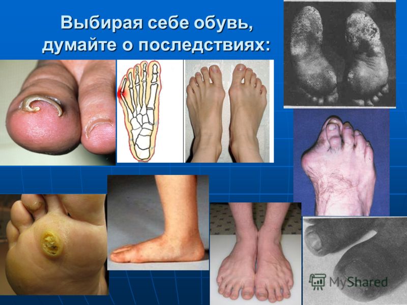 Подушка для ног при варикозе купить