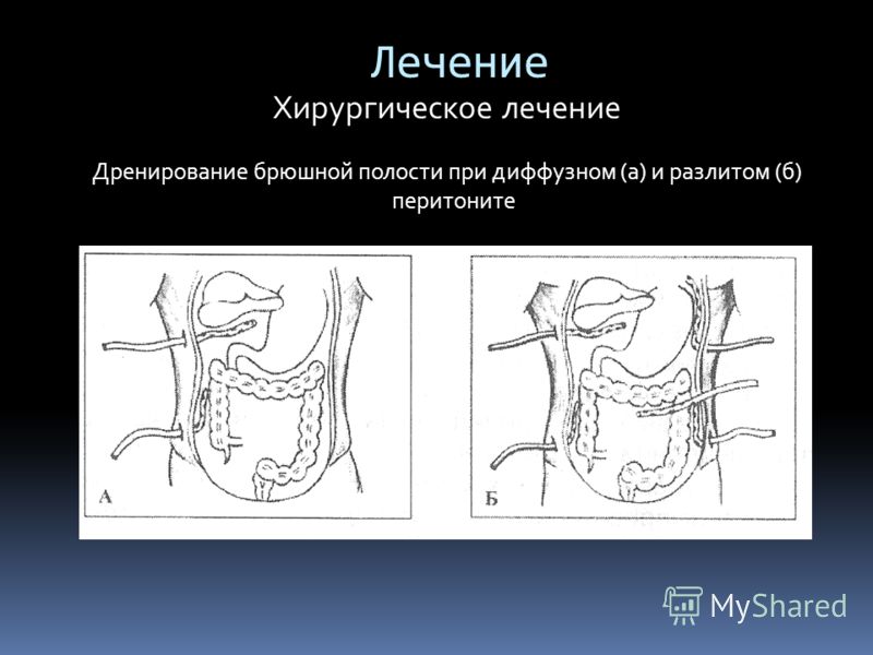 Лечение Хирургическое лечение Дренирование брюшной полости при диффузном (а) и разлитом (б) перитоните