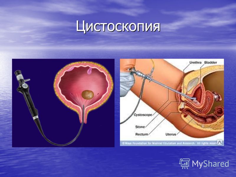 Как сделать цистографию Как сделать цистографию