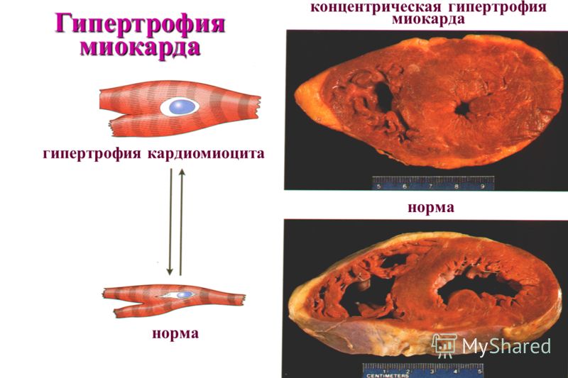 © П.Ф.Литвицкий, 2004 © ГЭОТАР-МЕД, 2004 норма концентрическая гипертрофия миокарда норма гипертрофия кардиомиоцита Гипертрофия миокарда