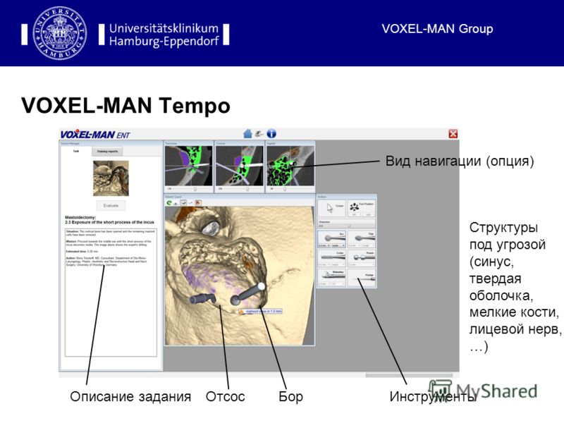 VOXEL-MAN Group VOXEL-MAN Tempo Описание заданияОтсосБорИнструменты Вид навигации (опция) Структуры под угрозой (синус, твердая оболочка, мелкие кости, лицевой нерв, …)