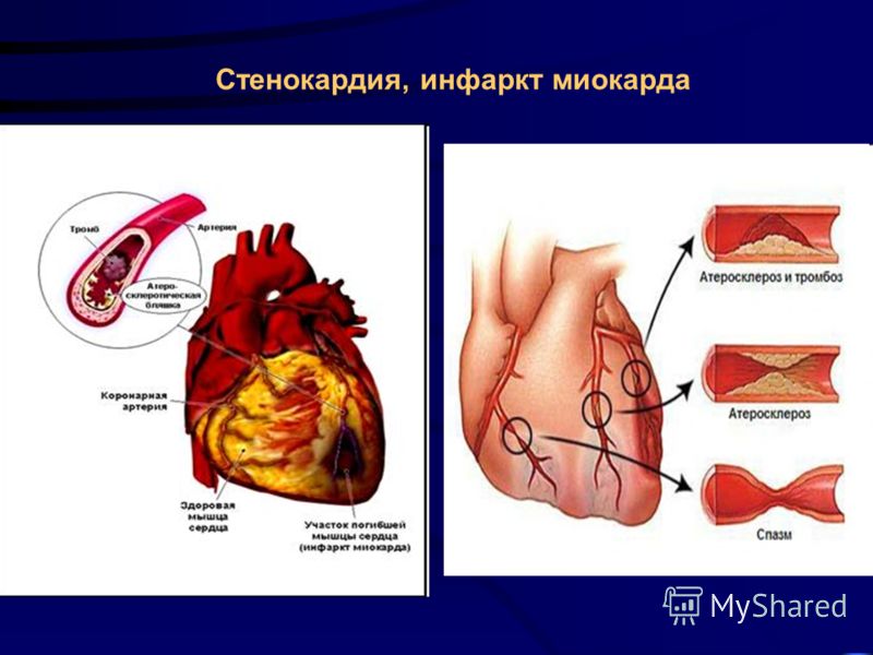 Стенокардия, инфаркт миокарда