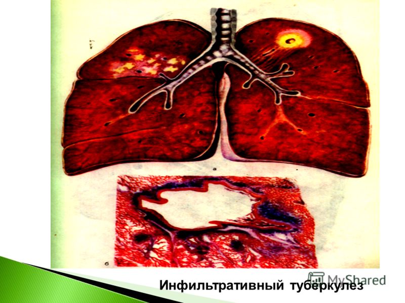 Инфильтративный туберкулез