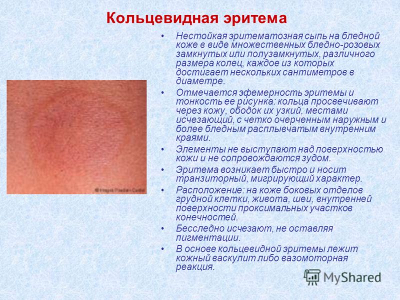 Кольцевидная эритема Нестойкая эритематозная сыпь на бледной коже в виде множественных бледно-розовых замкнутых или полузамкнутых, различного размера колец, каждое из которых достигает нескольких сантиметров в диаметре. Отмечается эфемерность эритемы