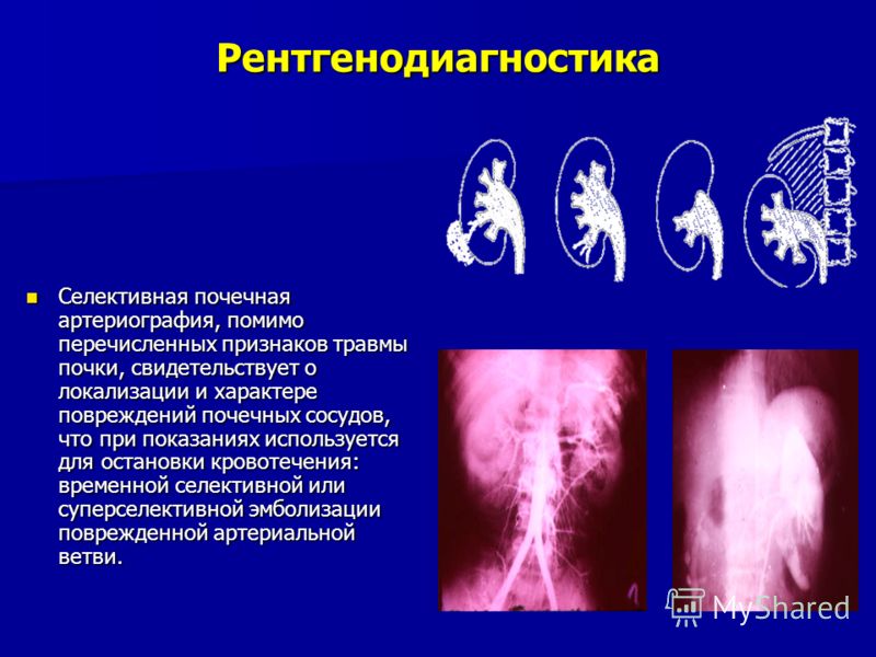 Рентгенодиагностика Селективная почечная артериография, помимо перечисленных признаков травмы почки, свидетельствует о локализации и характере повреждений почечных сосудов, что при показаниях используется для остановки кровотечения: временной селекти