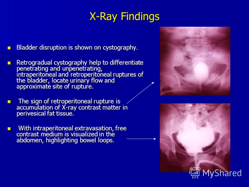 X-Ray Findings Bladder disruption is shown on cystography. Bladder disruption is shown on cystography. Retrogradual cystography help to differentiate penetrating and unpenetrating, intraperitoneal and retroperitoneal ruptures of the bladder, locate u