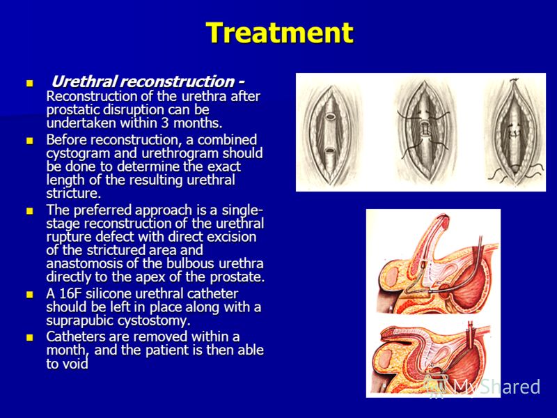 Treatment Urethral reconstruction - Reconstruction of the urethra after prostatic disruption can be undertaken within 3 months. Urethral reconstruction - Reconstruction of the urethra after prostatic disruption can be undertaken within 3 months. Befo