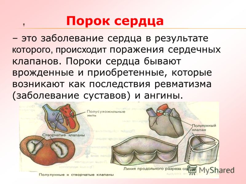 Презентация Пороки Сердца
