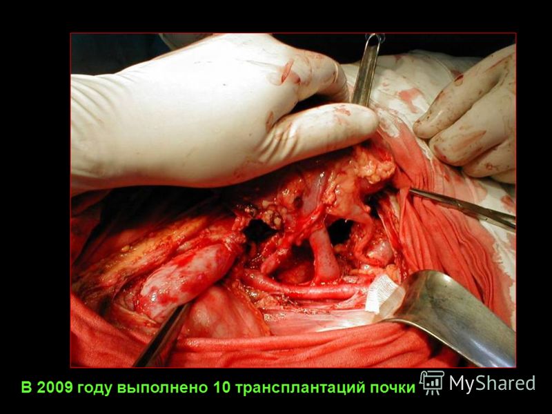 В 2009 году выполнено 10 трансплантаций почки