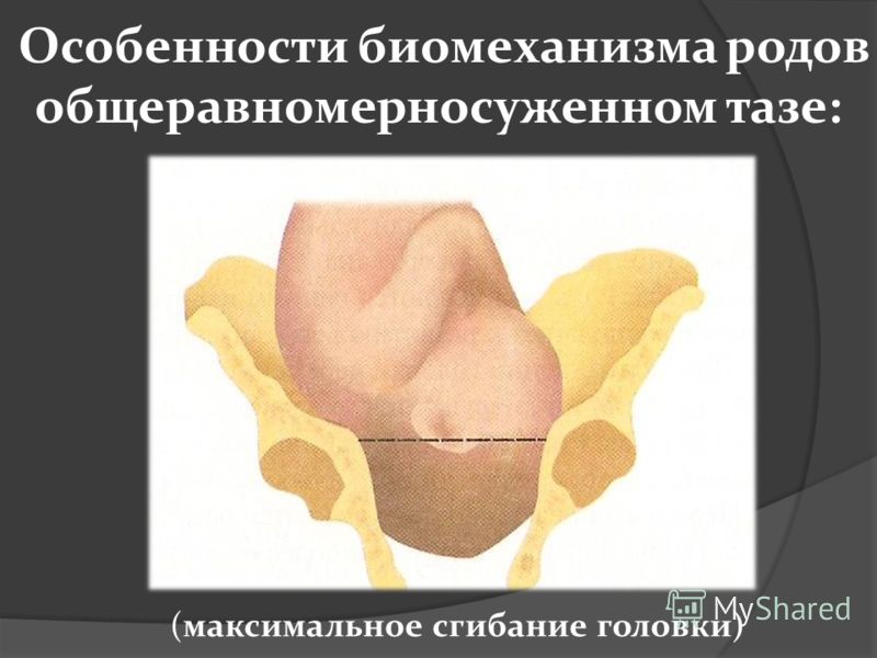 Роды при узком тазе 1 степени Роды при узком тазе 1 степени