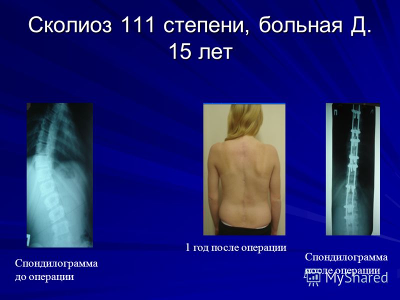 Осанка ее характеристики профилактика нарушения осанки