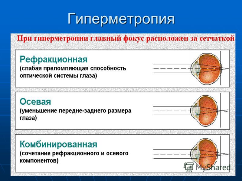 Человек с амблиопией