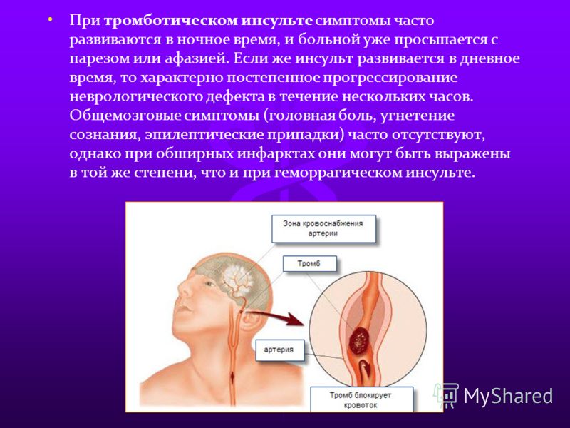как определить микроинсульт на майл завтра