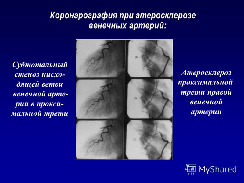 Как определить внешне уровень холестерина