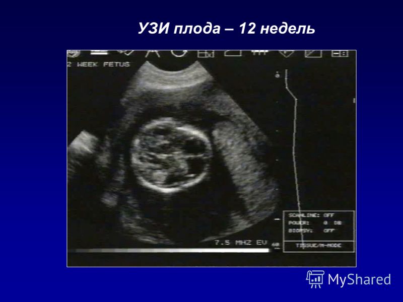 Результаты узи плод а в с Результаты узи плод а в с