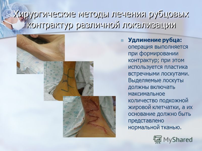 Пластика рубца местными тканями на коленном суставе. МРТ коленного сустава: что показывает, как проходит, плюсы и минусы Сумки Коленного Сустава — Buy-artox.ru Вывих коленного сустава: симптомы, методы лечения и реабилитации.