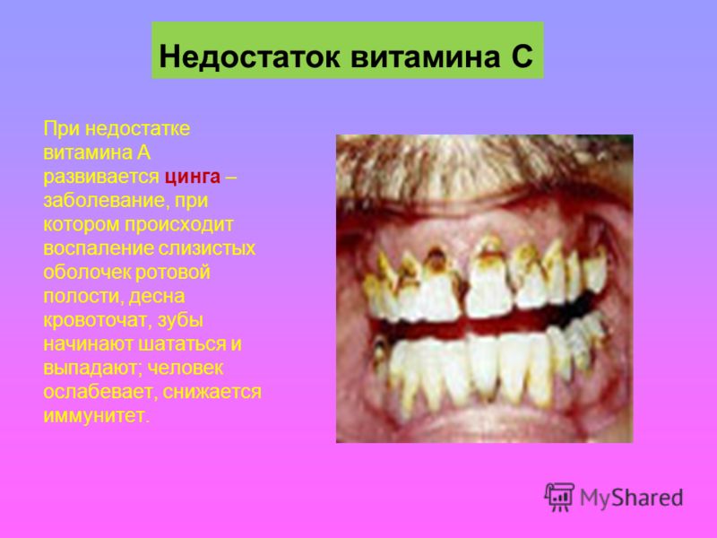 Почему возникает недостаток витамина а Почему возникает недостаток витамина а