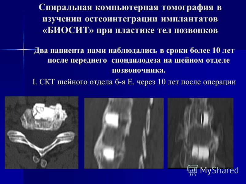Скт шейный отдел позвоночника Скт шейный отдел позвоночника