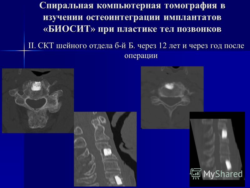 Скт шейный отдел позвоночника Скт шейный отдел позвоночника
