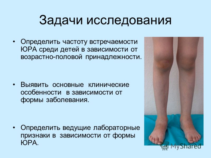 Первая помощь при подагре: снятие болевых приступов Обострение ревматоидного артрита правила ведения пациента