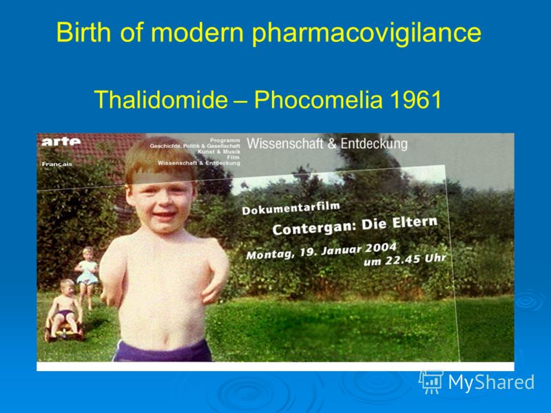 Birth of modern pharmacovigilance Thalidomide – Phocomelia 1961