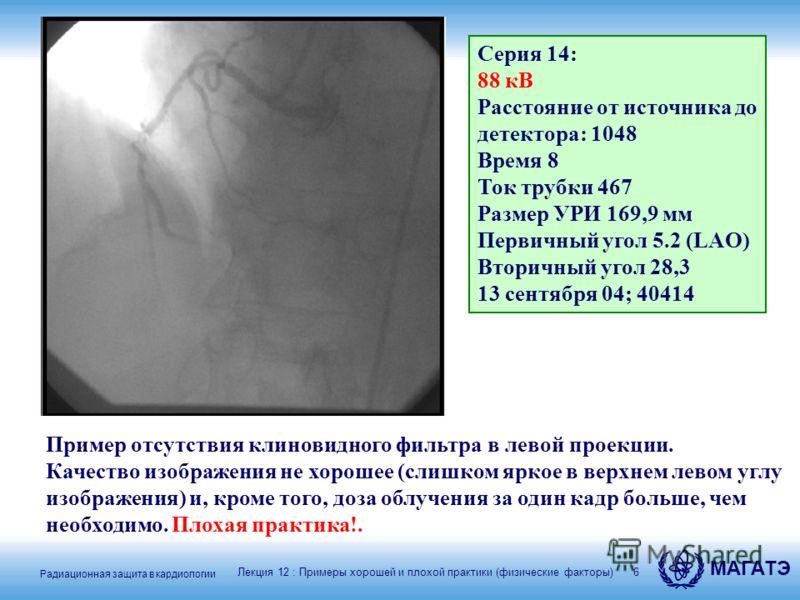Радиационная защита в кардиологии МАГАТЭ 6 Пример отсутствия клиновидного фильтра в левой проекции. Качество изображения не хорошее (слишком яркое в верхнем левом углу изображения) и, кроме того, доза облучения за один кадр больше, чем необходимо. Пл