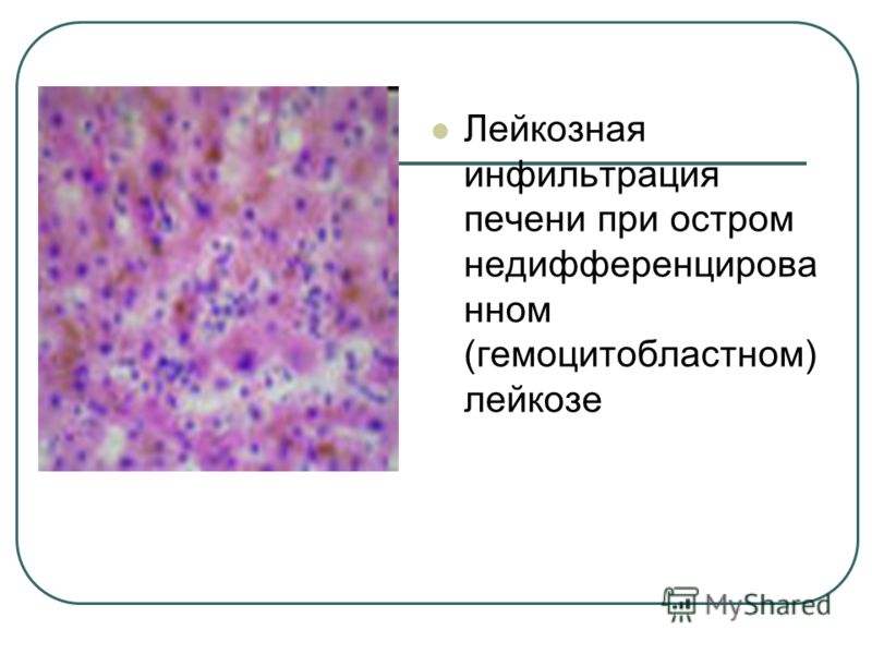 Лейкозная инфильтрация печени при остром недифференцирова нном (гемоцитобластном) лейкозе