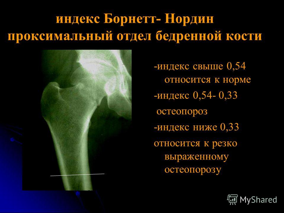 Бедренный отдел позвоночника Бедренный отдел позвоночника