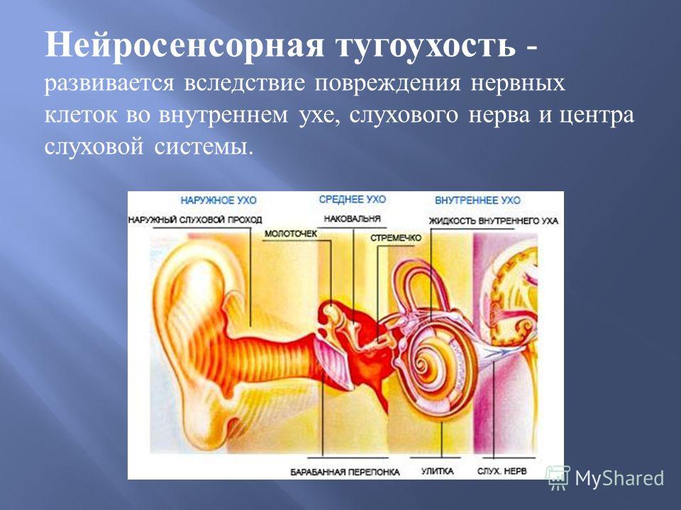 Как лечить тугоухость нейросенсорная тугоухость Как лечить тугоухость нейросенсорная тугоухость