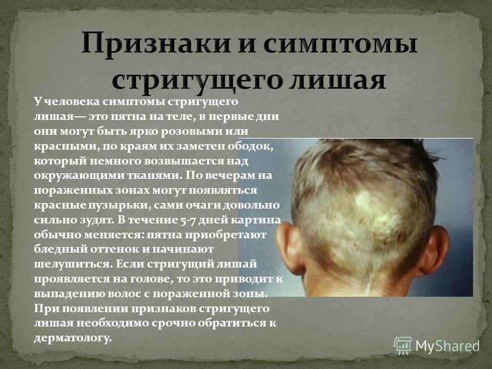 Лишай у детей и его уход Лишай у детей и его уход