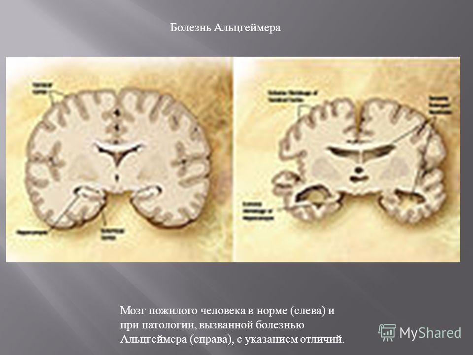 Мозг пожилого человека в норме (слева) и при патологии, вызванной болезнью Альцгеймера (справа), с указанием отличий. Болезнь Альцгеймера