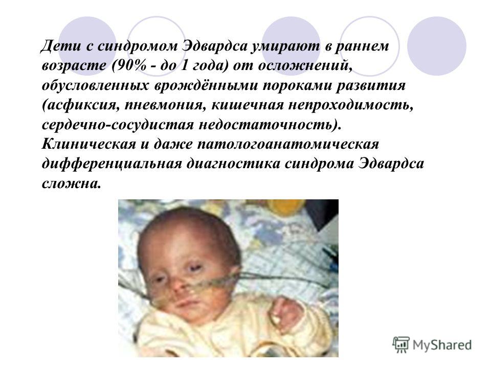 edwards syndrome edwards syndrome