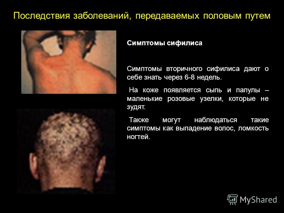 Узелки папулы на коже Узелки папулы на коже