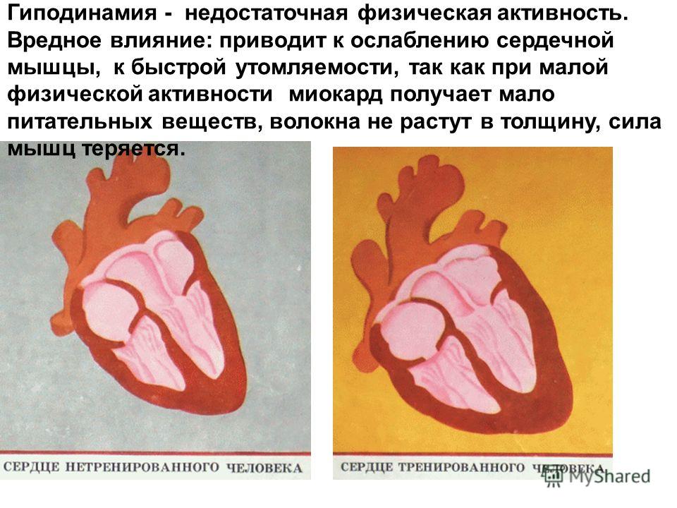 Гиподинамия что с этим связано Гиподинамия что с этим связано
