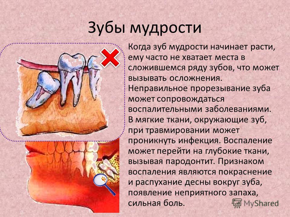 Материал для пломбировки каналов зубов Материал для пломбировки каналов зубов
