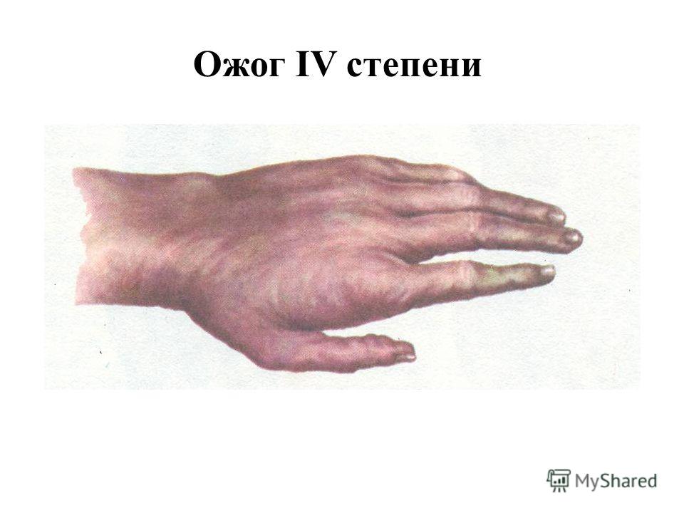 тест по теме ожоги