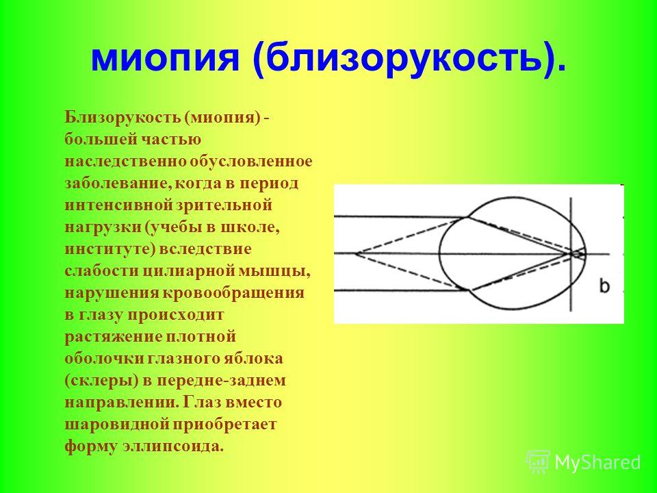 После операции смешанный астигматизм