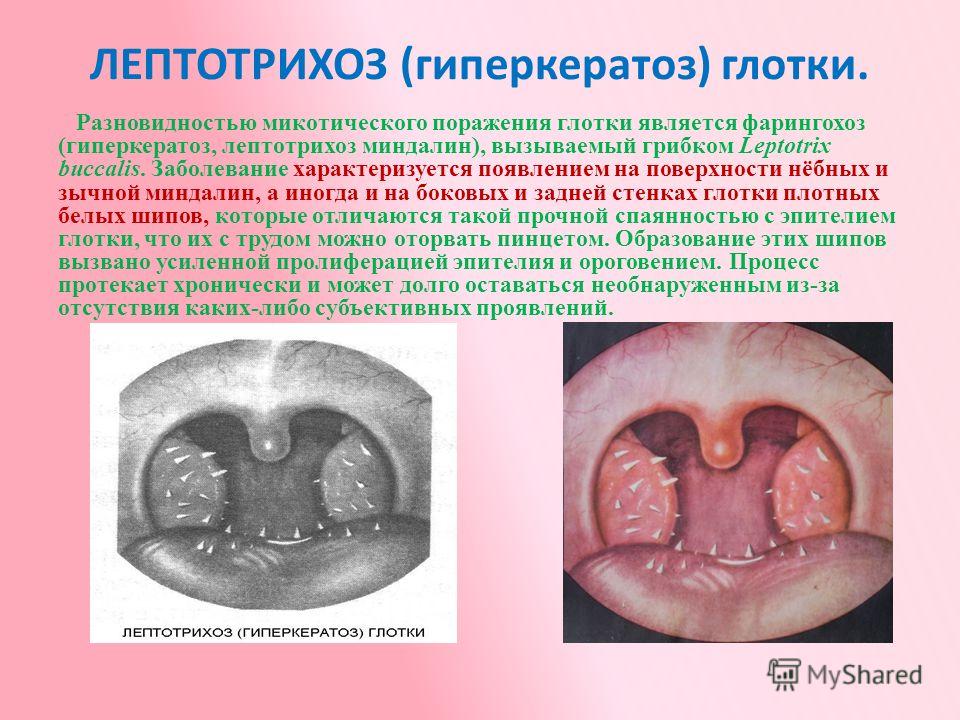 Виды Ангины Фото