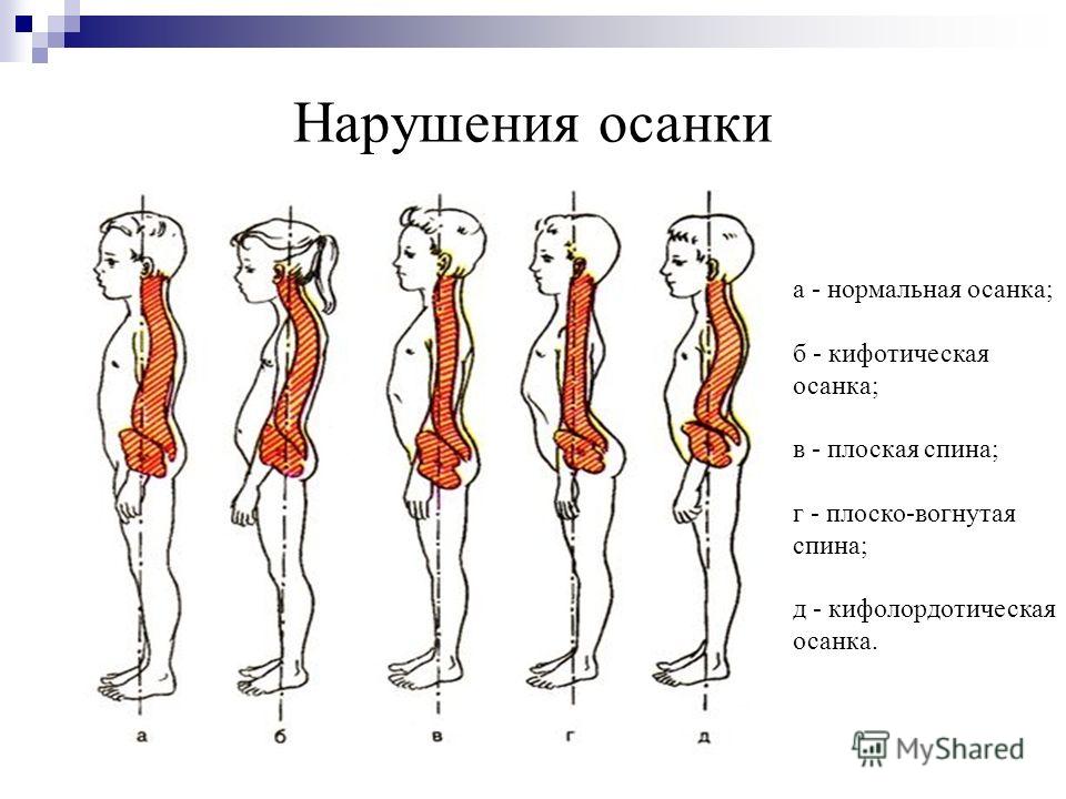 Реферат: Осанка и плоскостопие