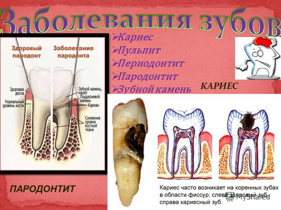 Кариес это заболевание зубов Кариес это заболевание зубов