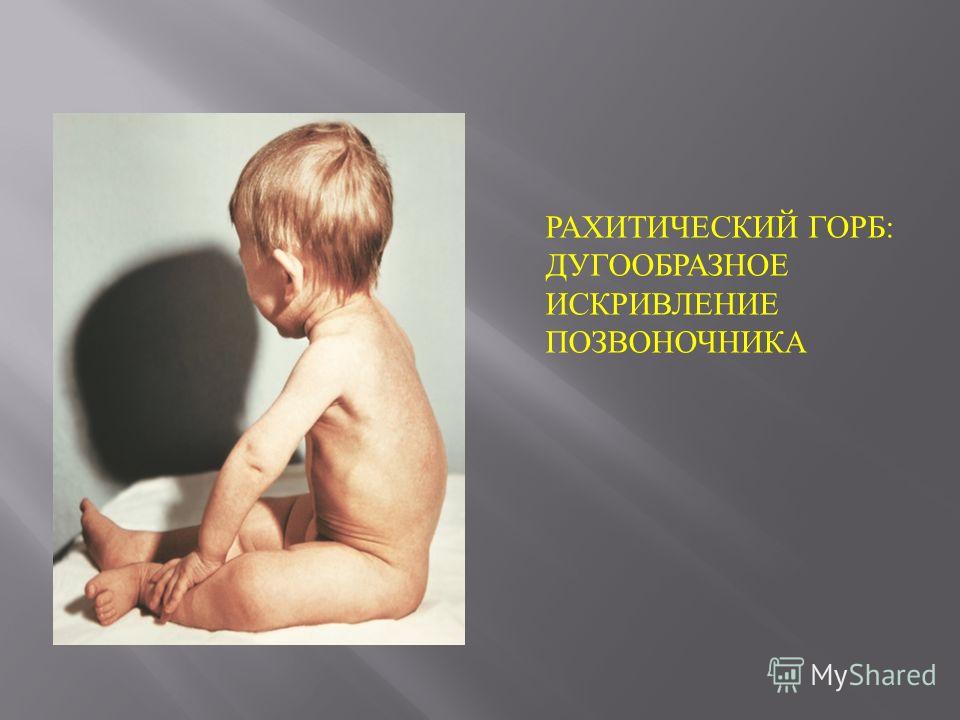 Диспластический сколиоз 1 степени лфк