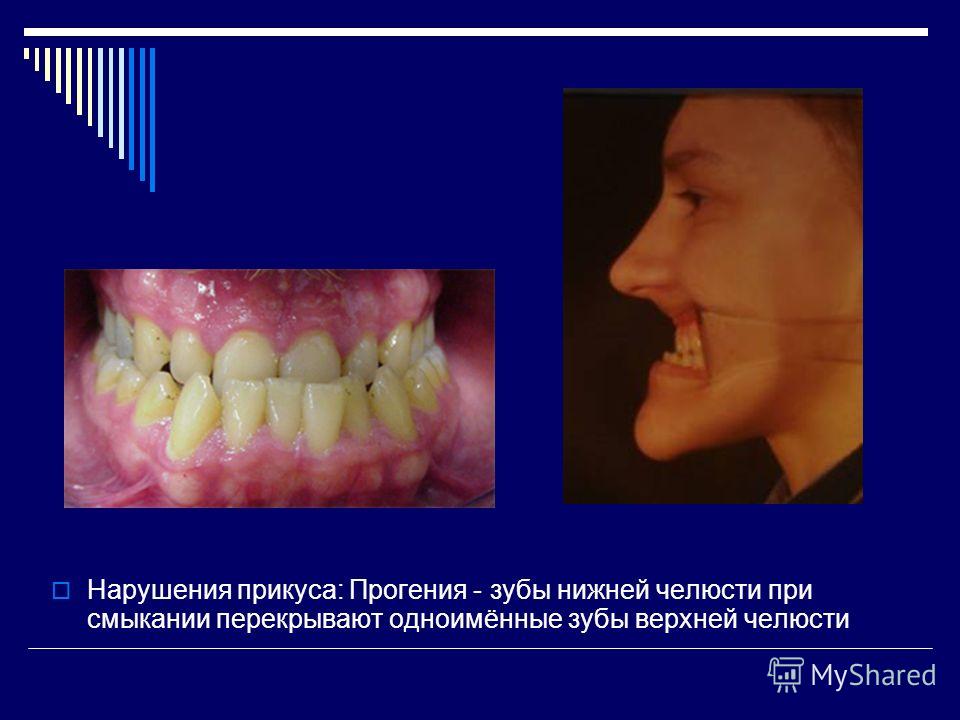 Нарушение строения зубов Нарушение строения зубов