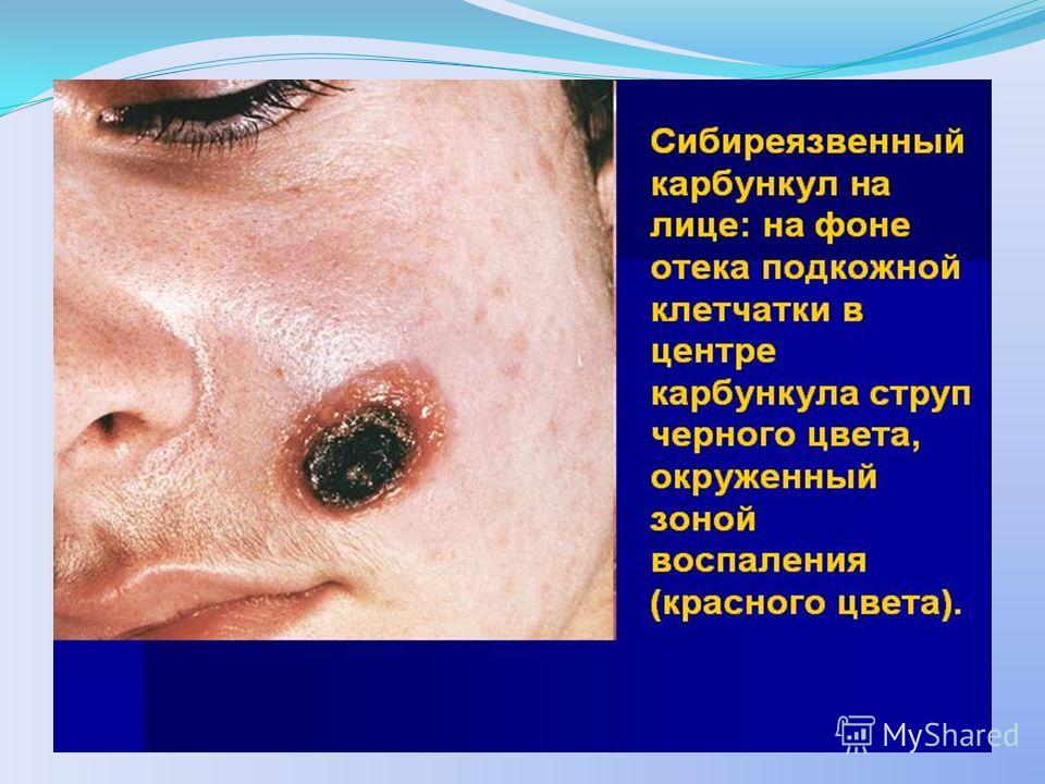 Местная инфекция кожи и подкожной клетчаткой Местная инфекция кожи и подкожной клетчаткой