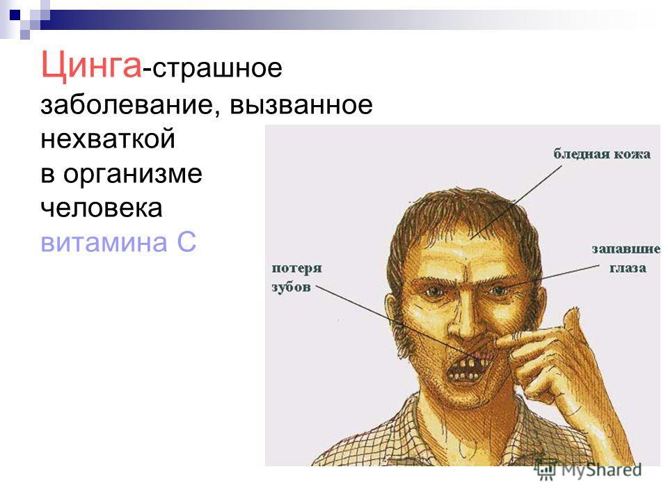 картинки почему люди болеют цингой онлайн картинки почему люди болеют цингой