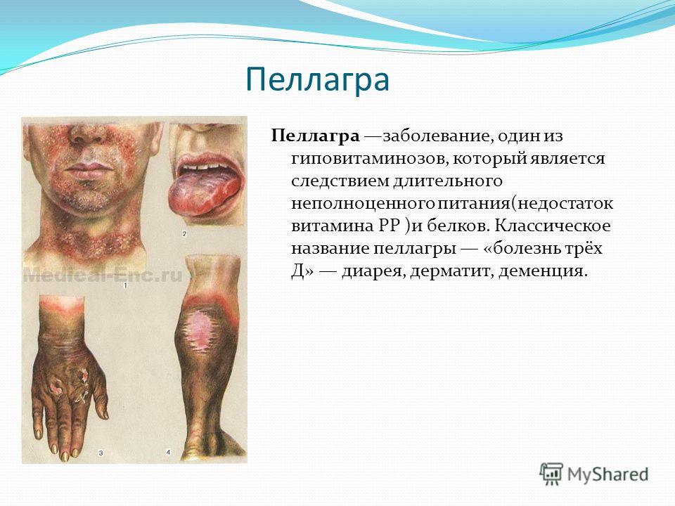 Поражение кожи при гиповитаминозах Поражение кожи при гиповитаминозах