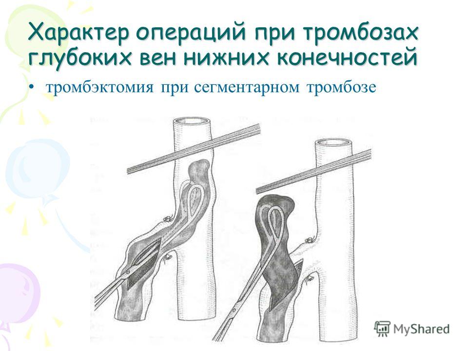 Эластичные чулки при тромбозах