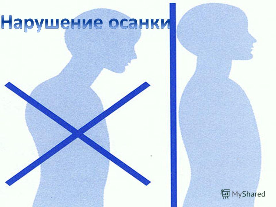 Кифоз позвоночника 50 градусов