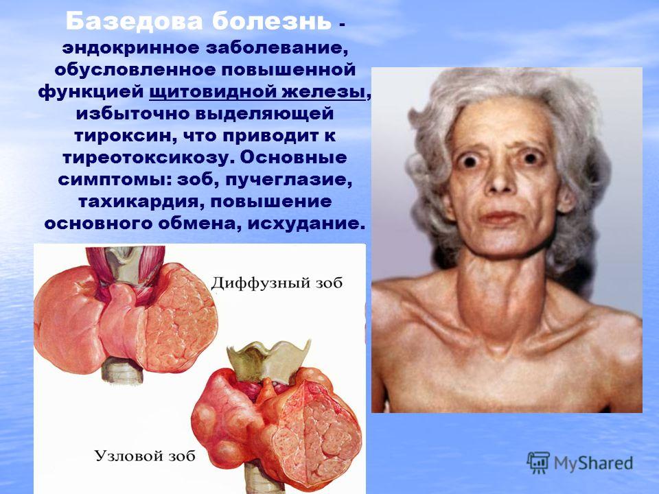 Болезнь связанная с избытком гормона щитовидной железы Болезнь связанная с избытком гормона щитовидной железы